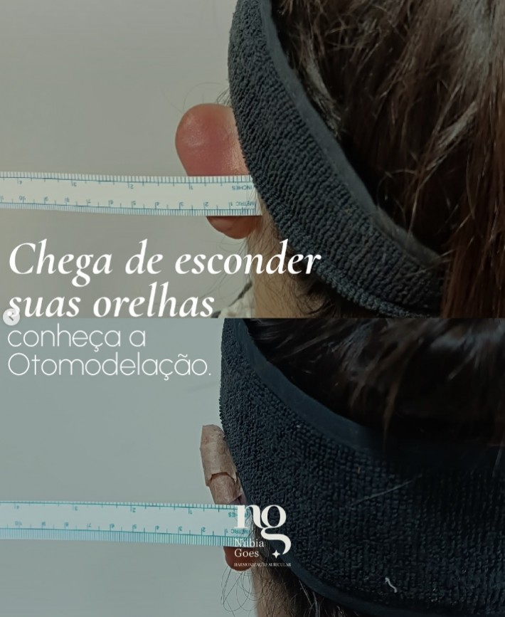 Postagem de Nubia Goes – Estética de Orelhas e Otomodelação